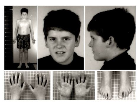 prader willi syndrome ncbi